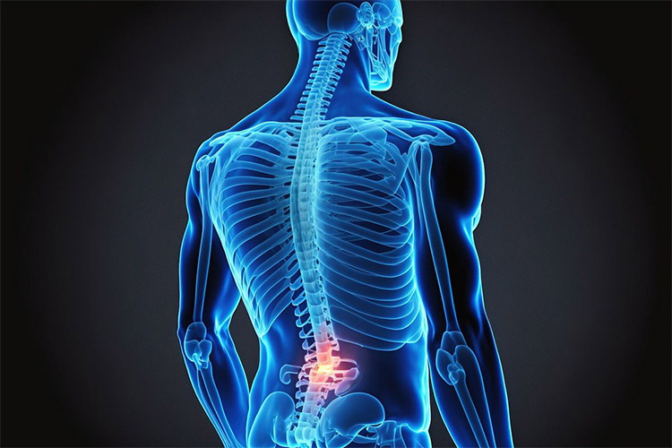 3d Image of Sciatica Pain treated at Legacy Chiropractic in Oklahoma City