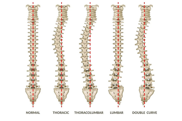 Types of Scoliosis and treatment options at Legacy Chiropractic in Oklahoma City
